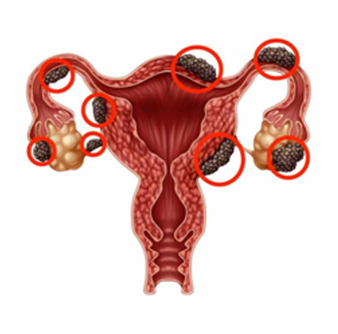 HORMONAL AND GYNECOLOGICAL DISORDERS